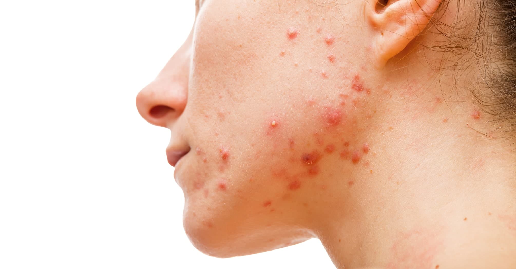 אקנה וצלקות אקנה